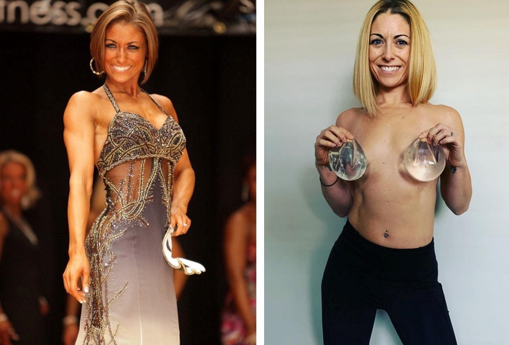 žena s prsními implantáty